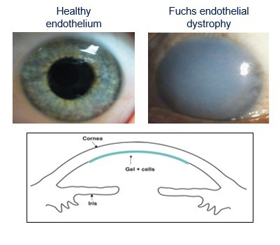 corneal disease image