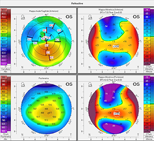 images of misshapen cornea