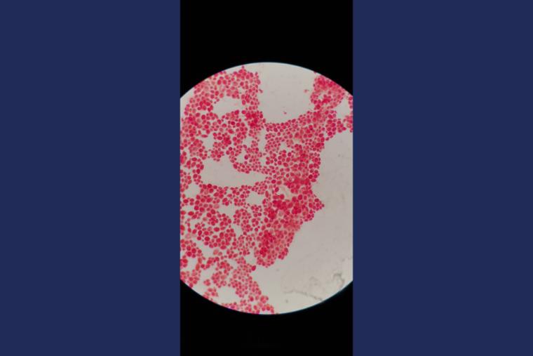 This is a Photo of stained Candida Alibicans Fungus under a microscope, the sample was taken from a Dialysis patient.