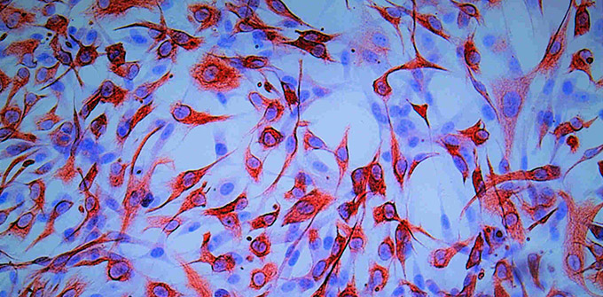 Uveal melanoma tissues under microscope