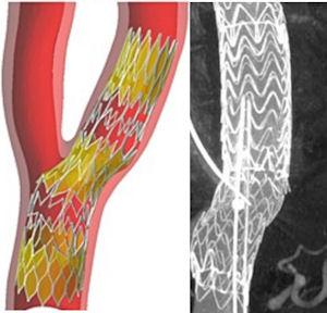 Modeling stent-vessel interaction