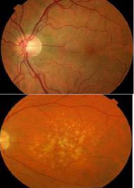 Development of bio-markers for images of the eye