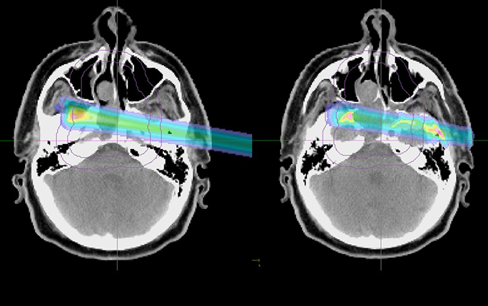 Left: Dose distribution of a given pencil beam. Right: Prompt gamma emission distribution of this pencil beam. Images courtesy of LMU. 