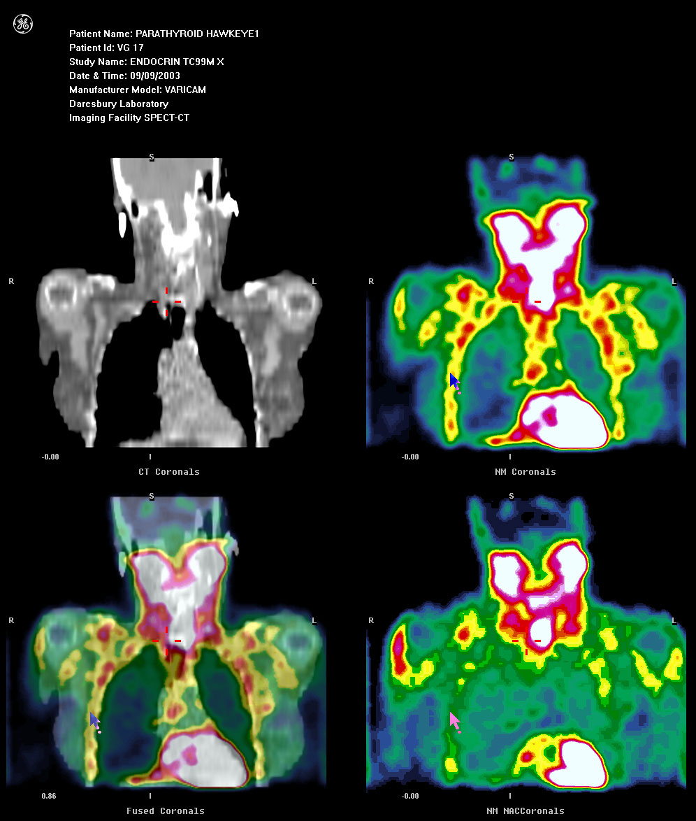 SPECT/CT scan using Tc99m on patient for MTRL images page