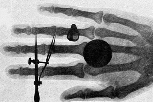 X-ray of a hand