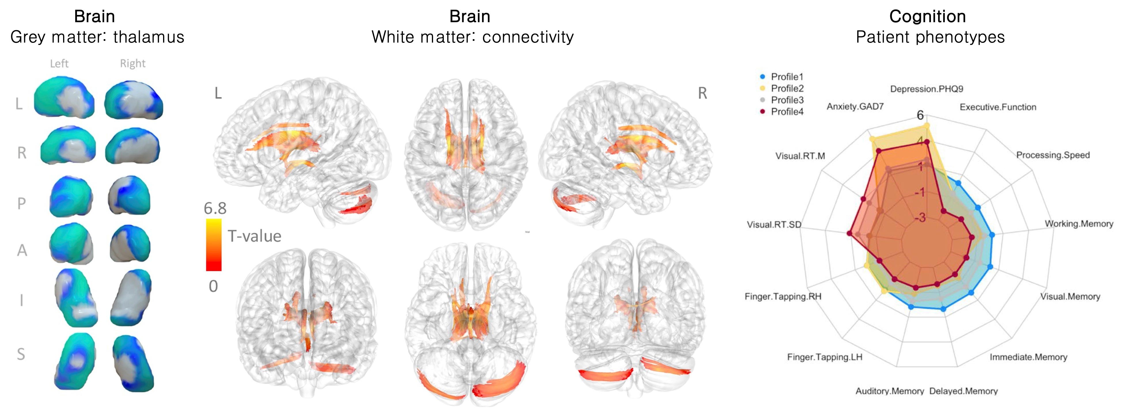 Image showing the brain and cognitive changes observed in people with newly diagnosed epilepsy resulting from MRI and neuropsychological assessment performed at LiMRIC