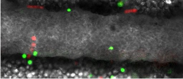 Scan of egg metastasis