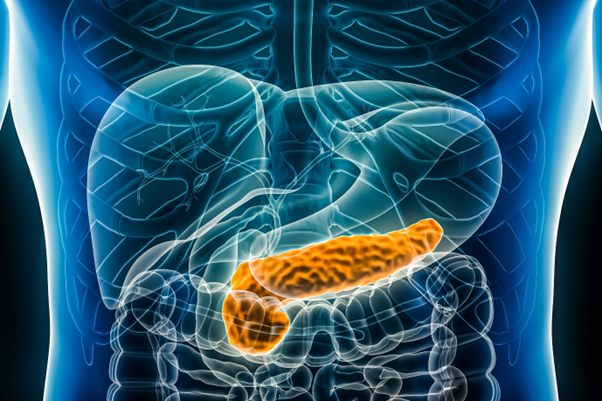 pancreatitis graphic