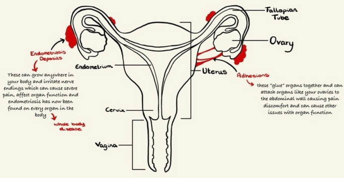 drawing of uterus to explain endometriosis by student doctor