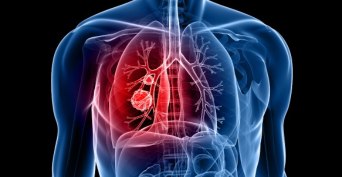 Spotlight: Lung cancer research in Liverpool