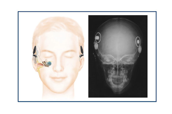 Audiology - Breaking the sound barrier